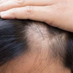 Akar Masalah Rambut Rontok Parah Pada Remaja