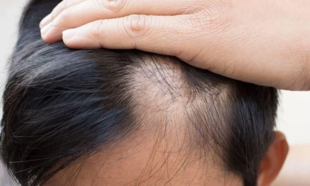 Akar Masalah Rambut Rontok Parah Pada Remaja