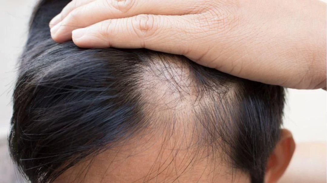 Akar Masalah Rambut Rontok Parah Pada Remaja